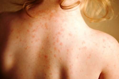 processionaria dermatite