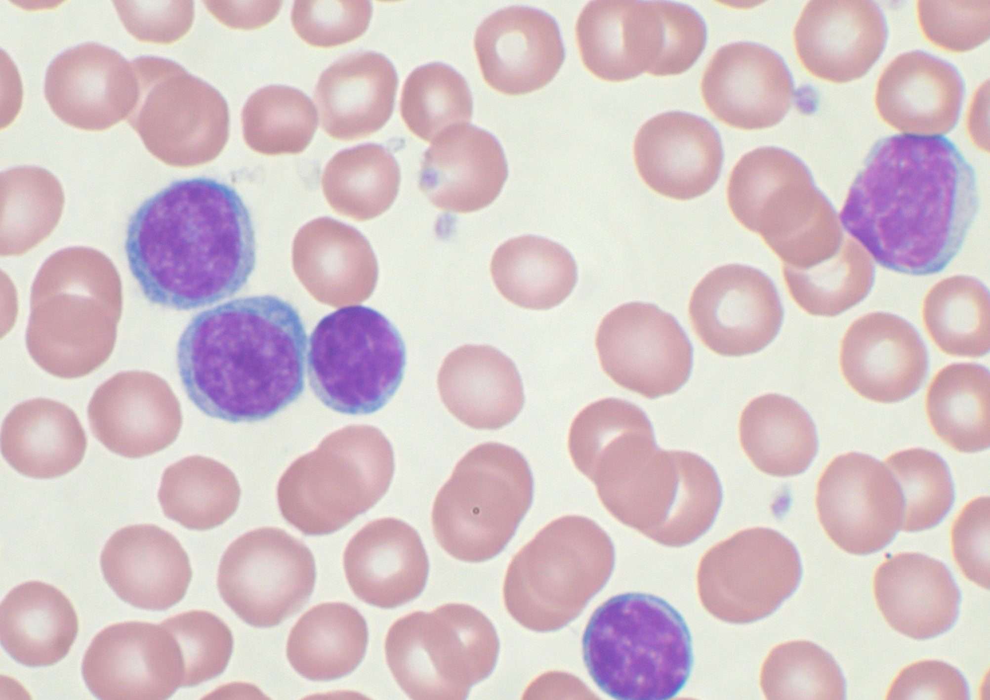 leucemia mieloide
